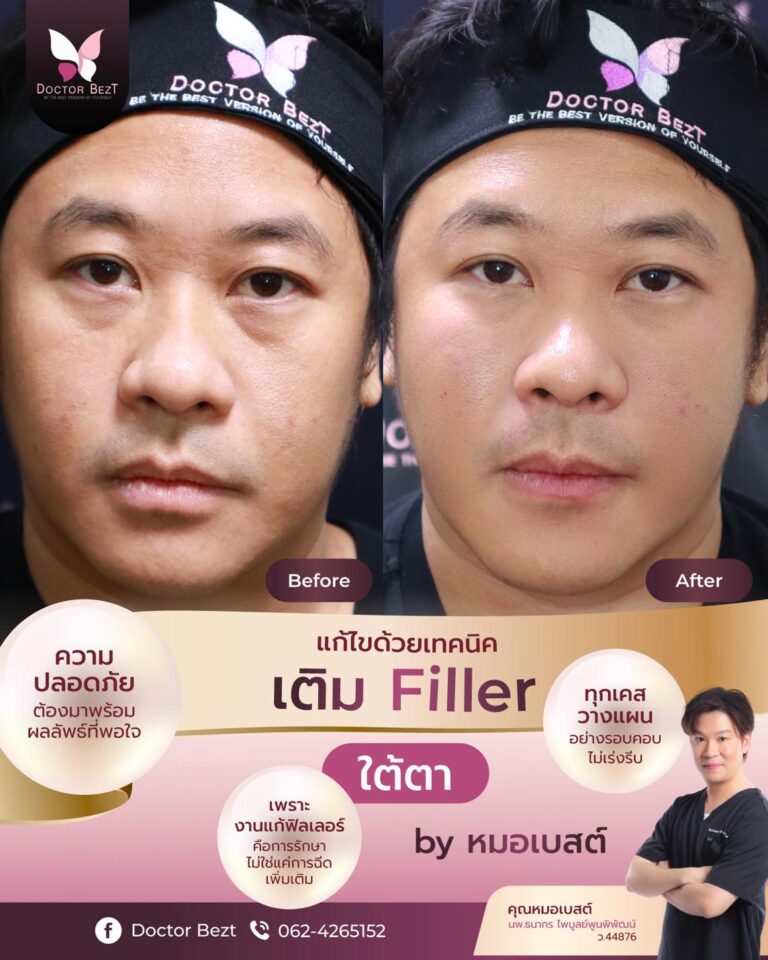 บอกลาหน้าโทรมเพราะใต้ตาลึกทำให้ดูเหนื่อยตลอดเวลา!