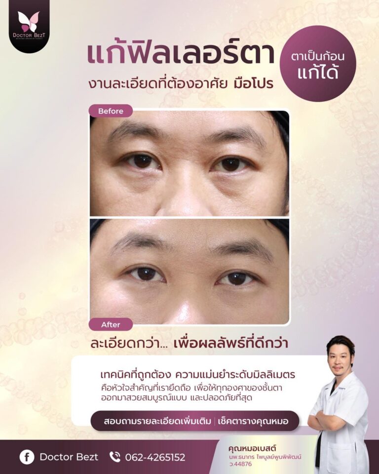 ใต้ตาเป็นก้อน ยิ้มแล้วพอง ไม่ใช่เรื่องตลก!