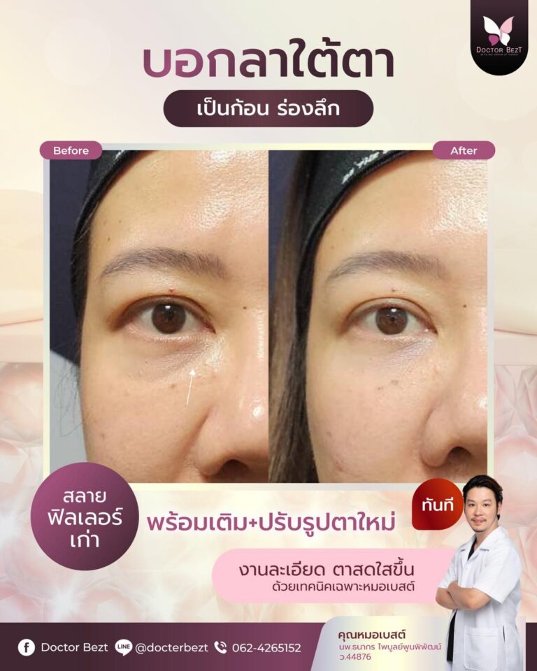 จบปัญหาใต้ตาเป็นก้อน ไม่ต้องทนเฟลอีกต่อไป!