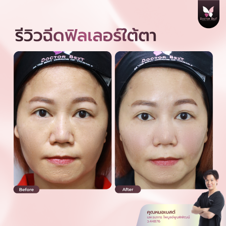 รีวิวฉีดฟิลเลอร์ใต้ตา-01