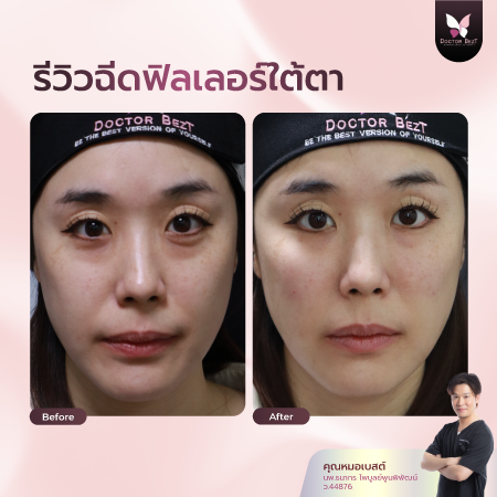 รีวิวฉีดฟิลเลอร์ใต้ตา-02