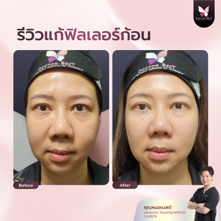รีวิวแก้ฟิลเลอร์ก้อน-01