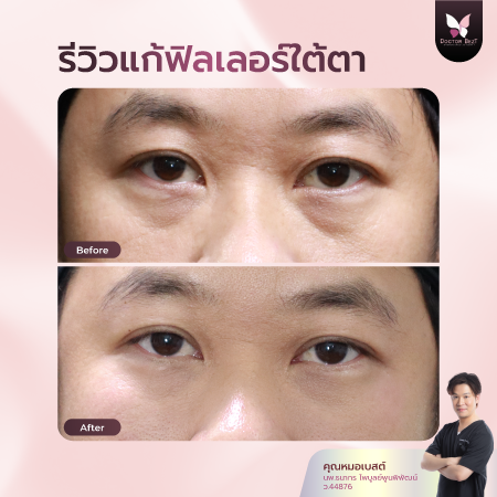 รีวิวแก้ฟิลเลอร์ก้อน-02